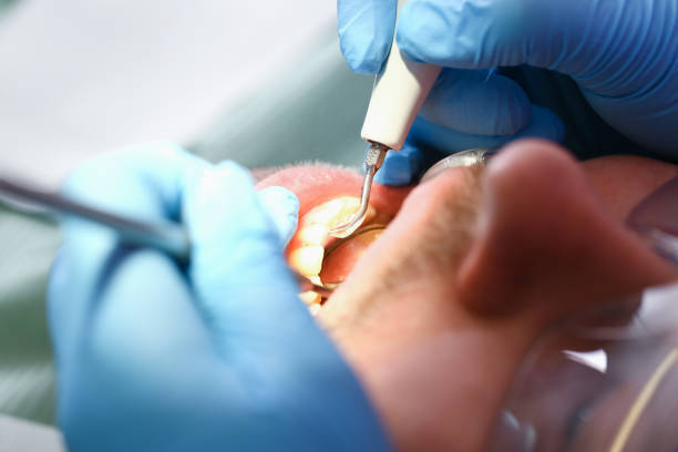 Best Emergency Root Canal Treatment in Farmville, VA
